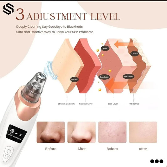 Portable Blackhead Vacuum Remover